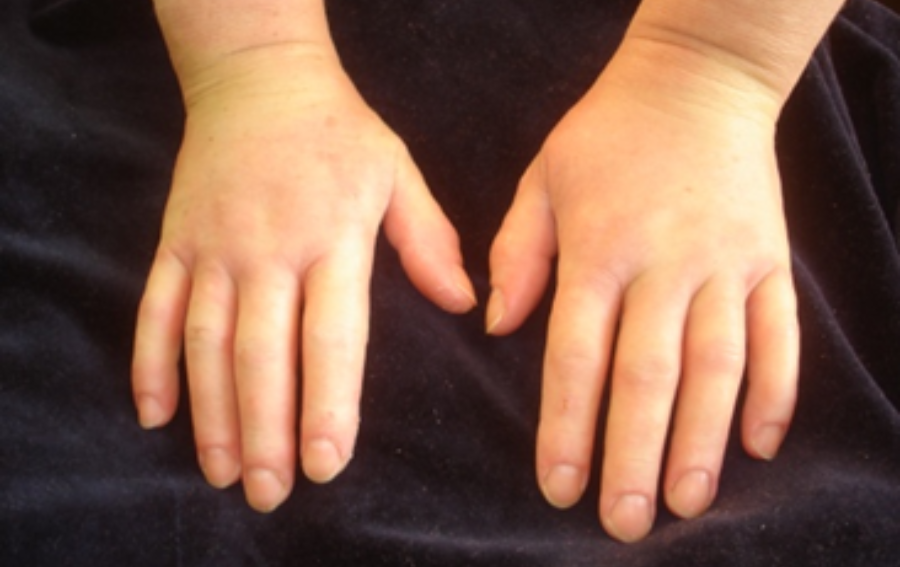 Nowa możliwość terapii biologicznej w Poradni Reumatologicznej UCK WUM